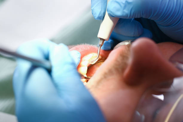 Best Emergency Tooth Extraction in Cary, IL